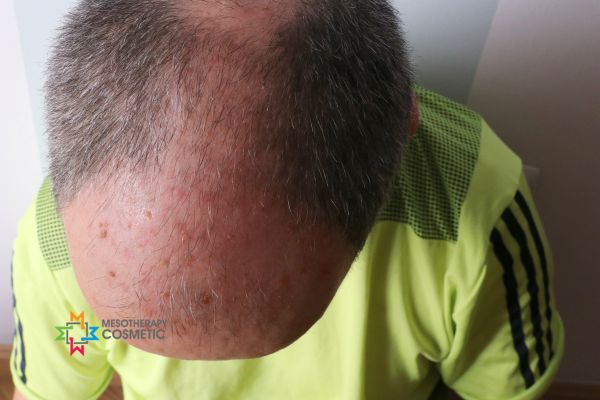 Actinic Keratoses Removal